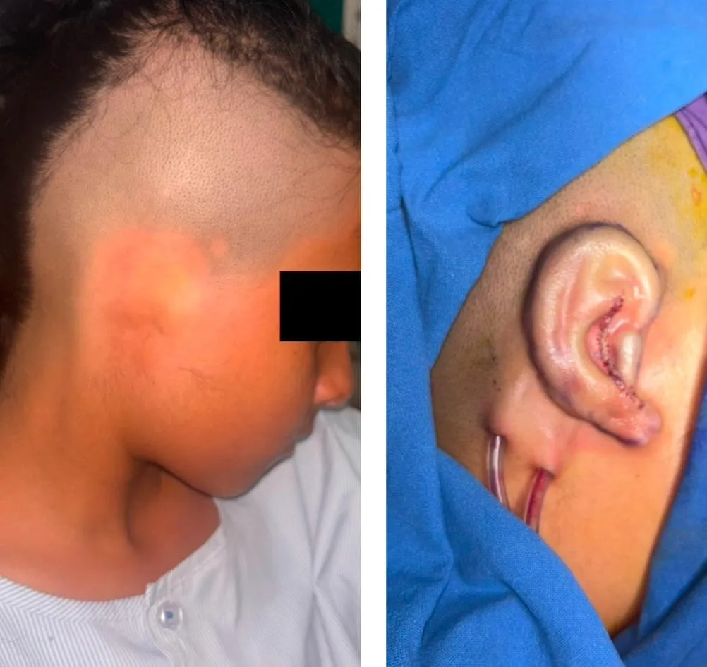 Microtia surgery case in India showing ear reconstruction outcome