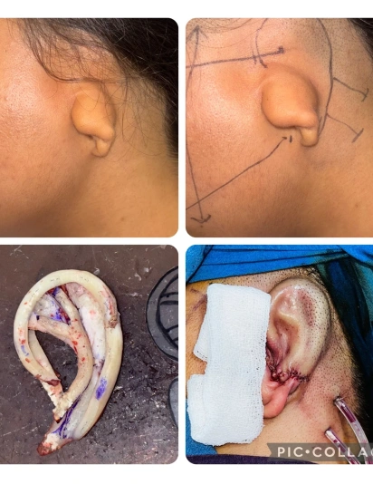 Microtia ear reconstruction stages showing underdeveloped ear, surgical markings, cartilage framework, and post-surgery ear shape